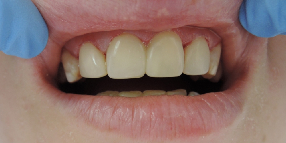 Виниры на 4 передних верхних зуба - фото №2