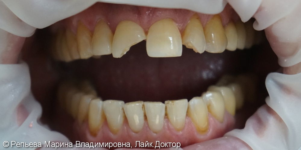 Эстетическая реставрация значительно травмированных передних зубов - фото №1