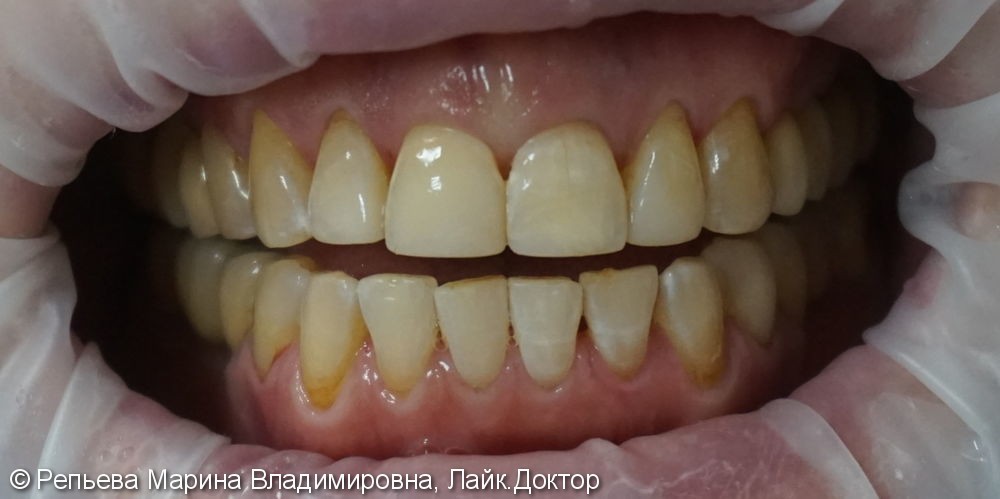 Эстетическая реставрация значительно травмированных передних зубов - фото №2