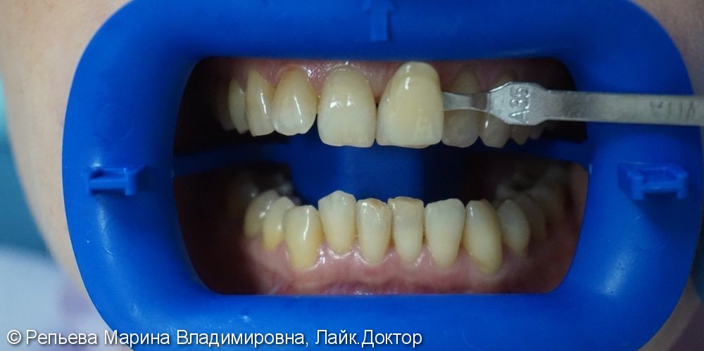 Результат отбеливания зубов и профессиональной чистки - фото №1