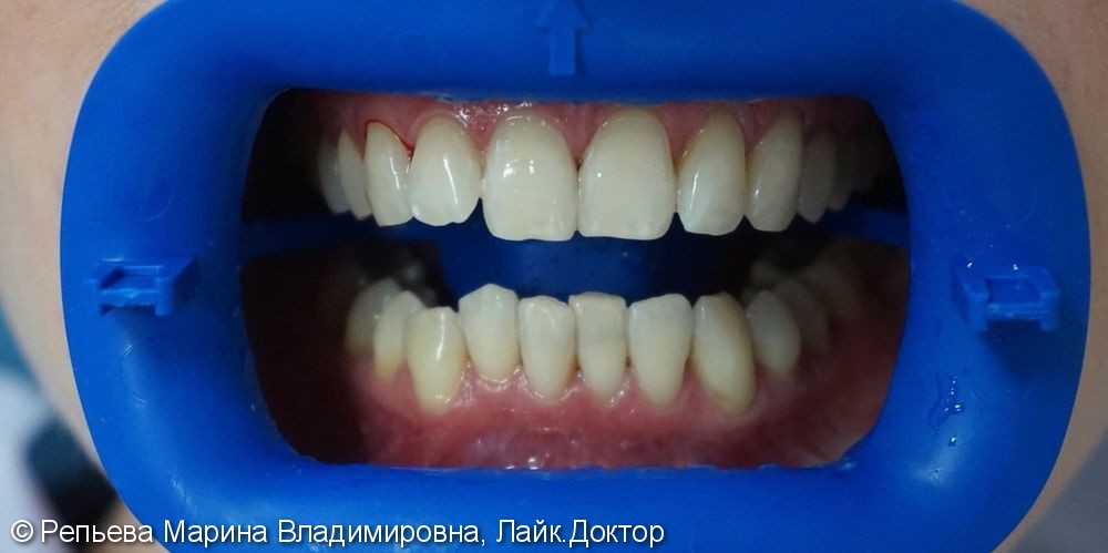 Результат отбеливания зубов и профессиональной чистки - фото №2