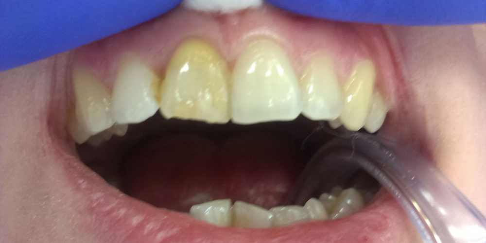 Внутриканальное отбеливание переднего зуба Opalescense Endo - фото №1