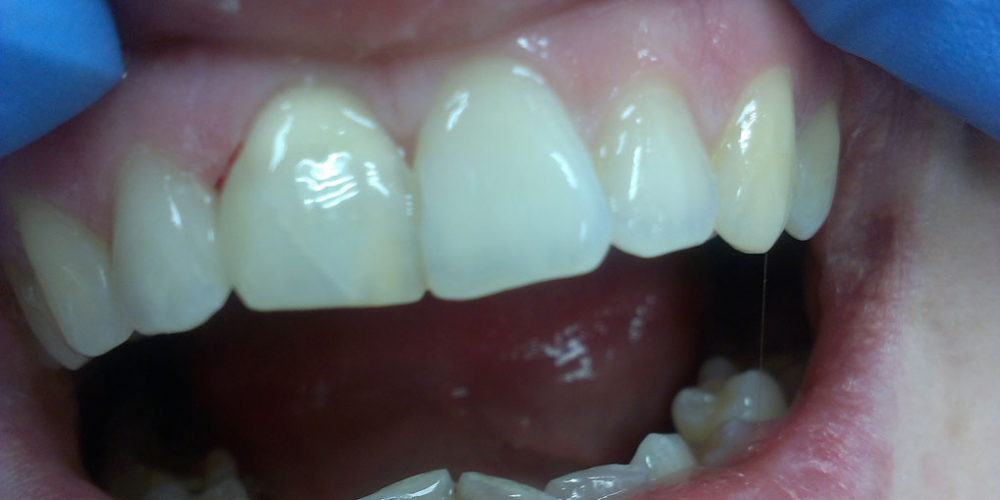 Внутриканальное отбеливание переднего зуба Opalescense Endo - фото №3