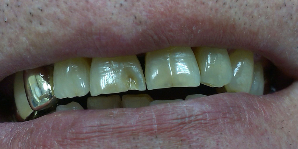 Результат реставрации скола режущего края зуба композитом - фото №1