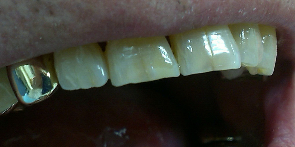 Результат реставрации скола режущего края зуба композитом - фото №2