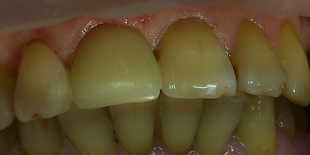 Художественная реставрация передних зубов - фото №2