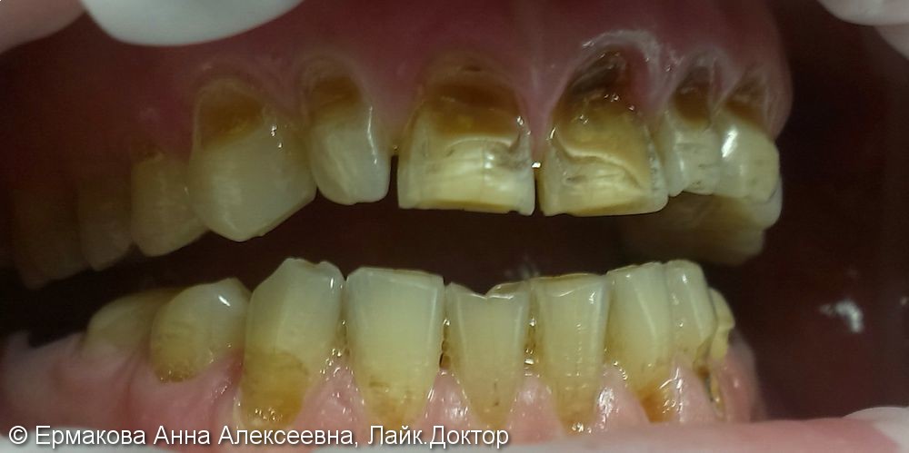 Тотальная реставрация фронтальной группы зубов - фото №1
