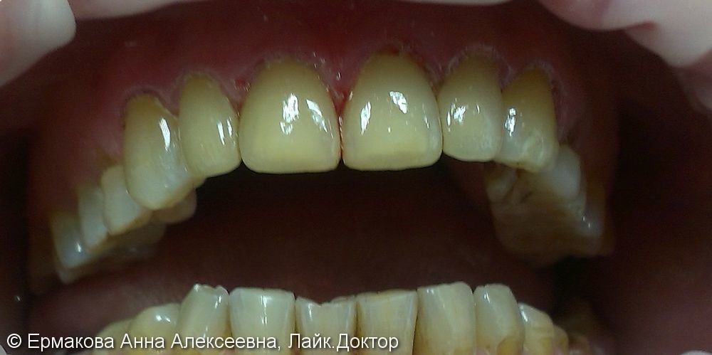 Тотальная реставрация фронтальной группы зубов - фото №2