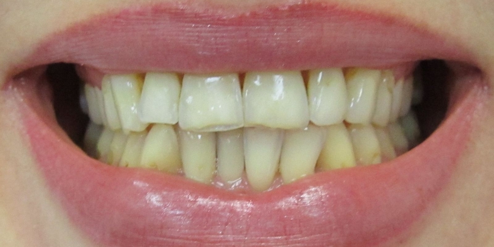 Керамические (безметалловые) коронки E-Max (6 верхних зубов) - фото №1