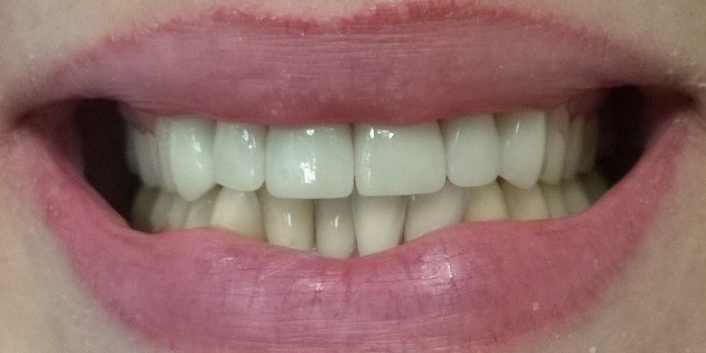 Керамические (безметалловые) коронки E-Max (6 верхних зубов) - фото №2