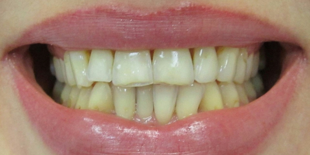Протезирование передних зубов цельнокерамические коронки E-Max - фото №1