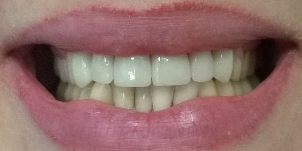 Протезирование передних зубов цельнокерамические коронки E-Max - фото №6