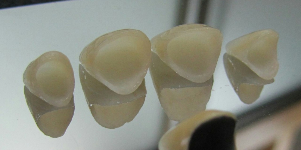 Цельнокерамические коронки e-max на передние зубы - фото №4