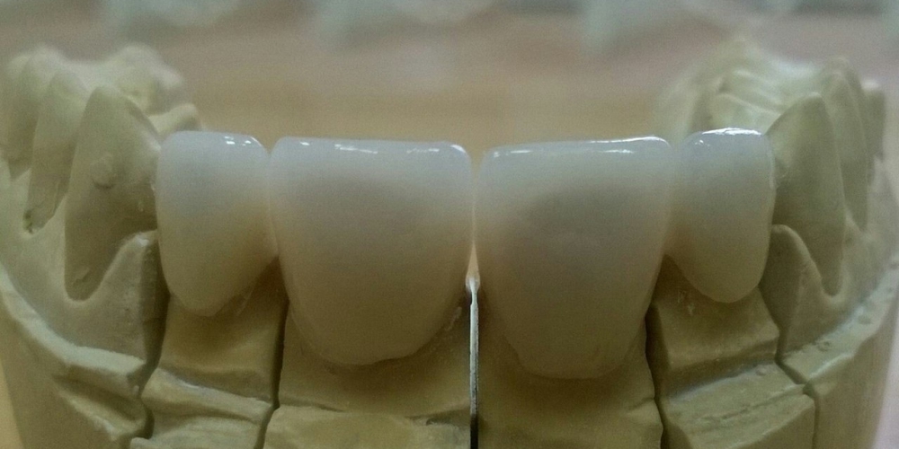 Цельнокерамические коронки e-max на передние зубы - фото №5