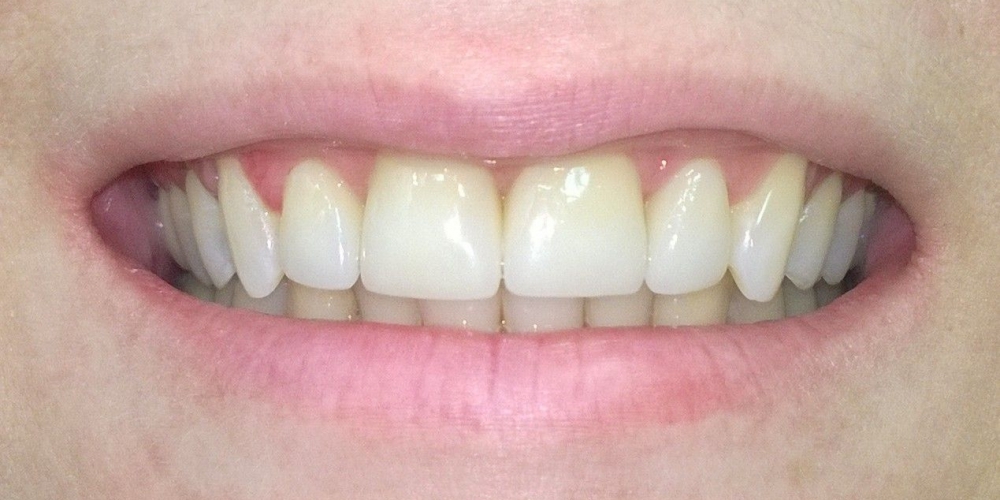 Цельнокерамические коронки e-max на передние зубы - фото №6