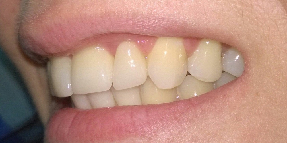 Цельнокерамические коронки e-max на передние зубы - фото №2