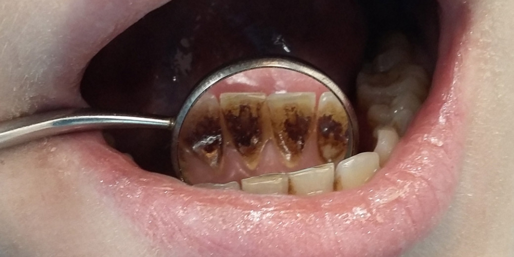 Чистка зубного налета и снятие зубного камня - фото №1