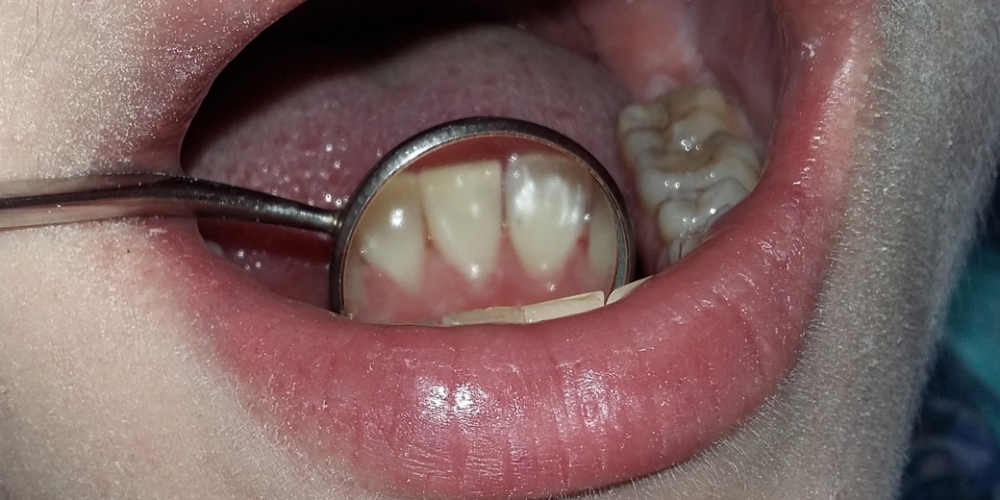 Чистка зубного налета и снятие зубного камня - фото №2