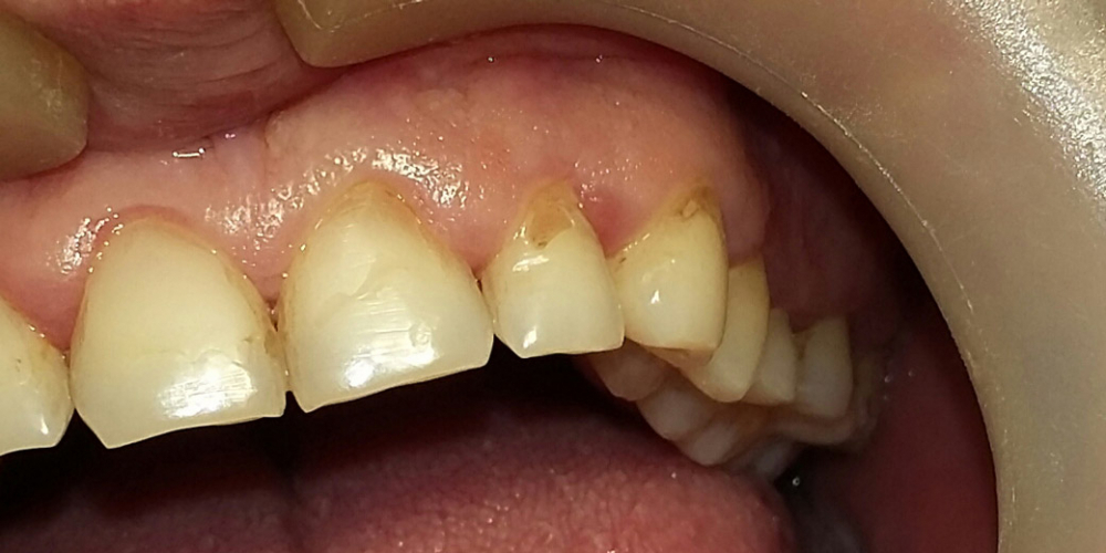 Реставрация клиновидного дефекта зубов - фото №1