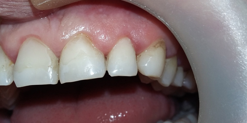 Реставрация клиновидного дефекта зубов - фото №2