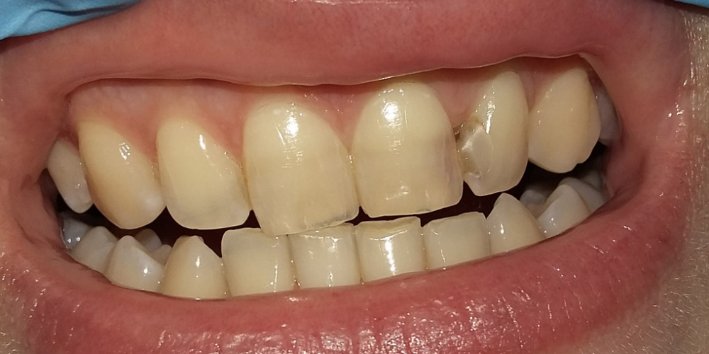 Эстетическая реставрация двух передних зубов - фото №1