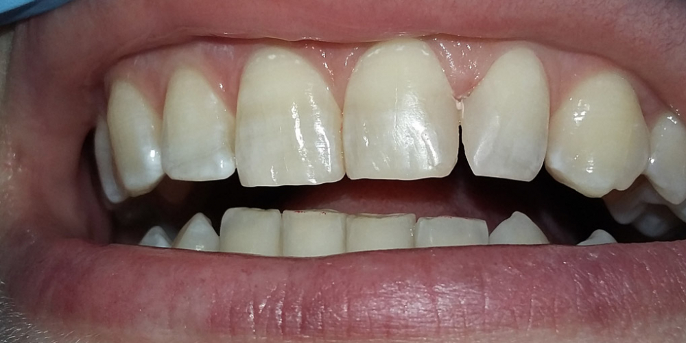 Эстетическая реставрация двух передних зубов - фото №3