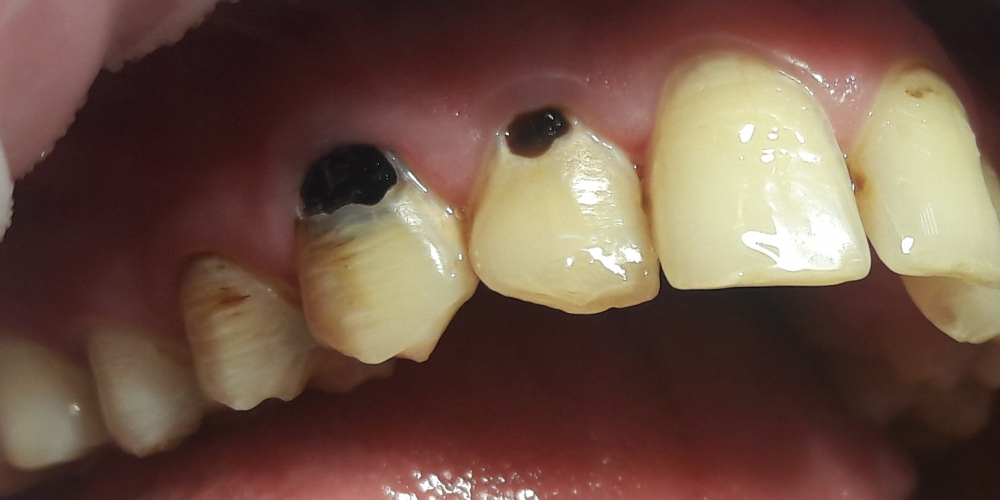 Реставрация фронтальных зубов, пораженных множественным кариесом - фото №1