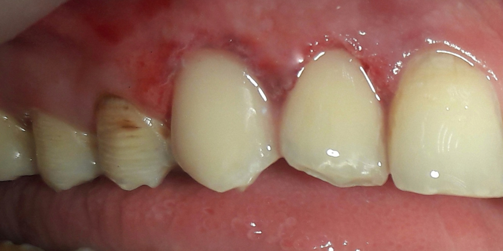 Реставрация фронтальных зубов, пораженных множественным кариесом - фото №2