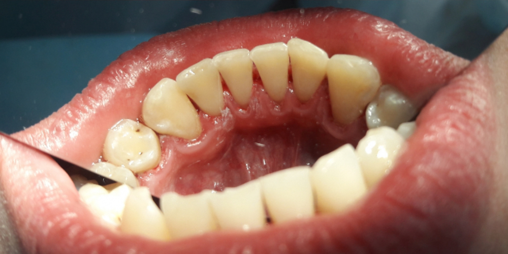 Профессиональная гигиена полости рта (снятие налета и камня) - фото №2