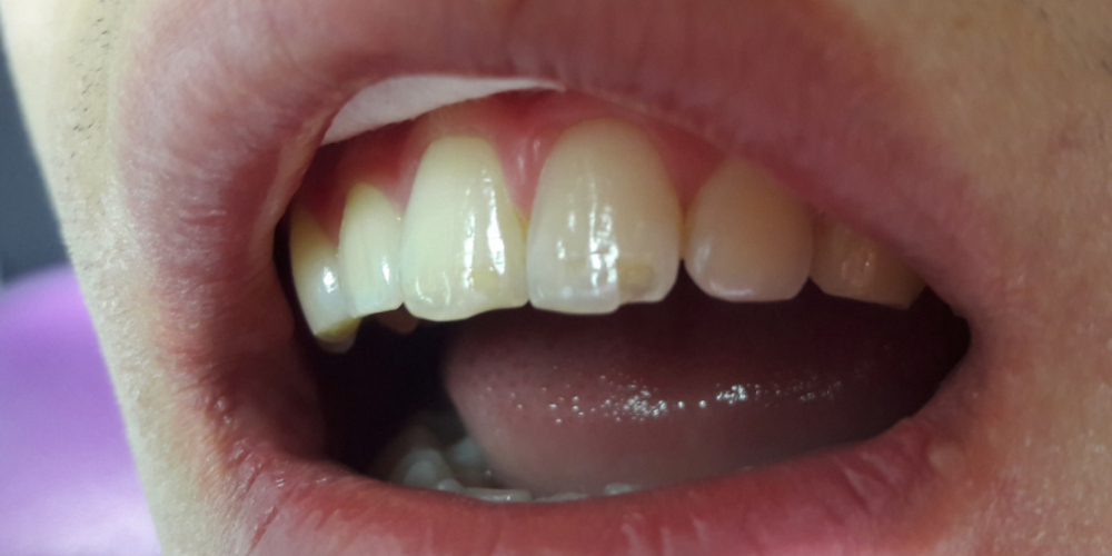 Восстановление режущего края переднего зуба - фото №1