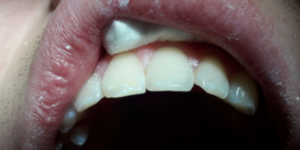 Восстановление режущего края переднего зуба - фото №2
