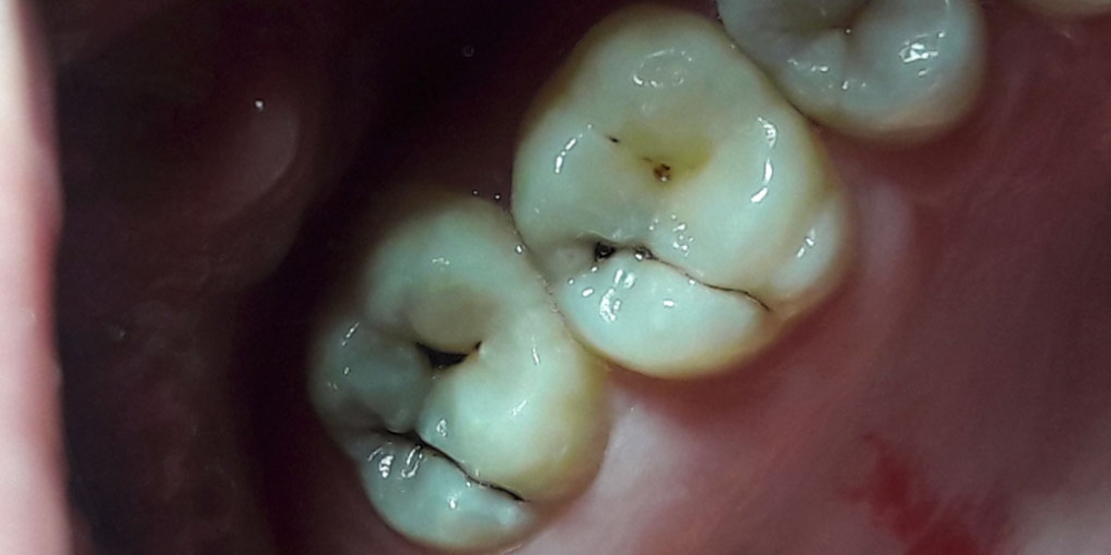 Лечение кариеса, реставрация жевательных зубов, жалоба на боль в зубах - фото №1