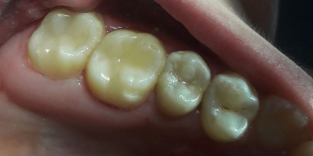 Лечение кариеса, реставрация жевательных зубов, жалоба на боль в зубах - фото №2
