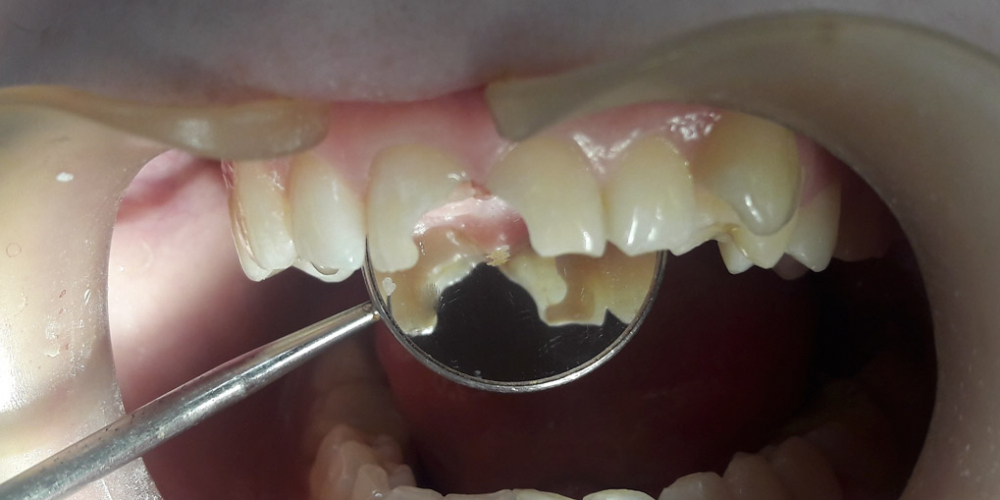 Художественная реставрация передних зубов композитным материалом - фото №2