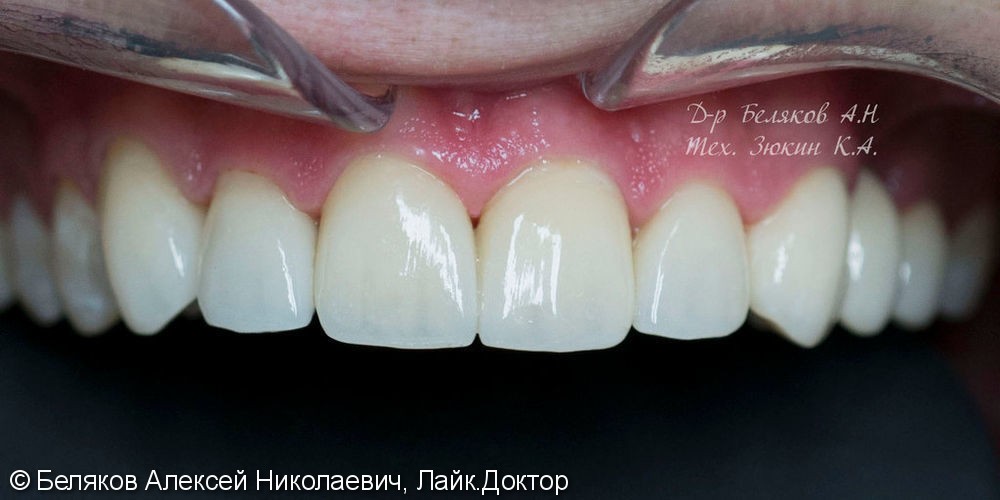 Эстетическое протезирование фронтальной группы зубов верхней челюсти - фото №2