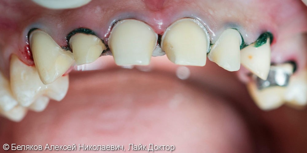 Эстетическое протезирование фронтальной группы зубов верхней челюсти - фото №1