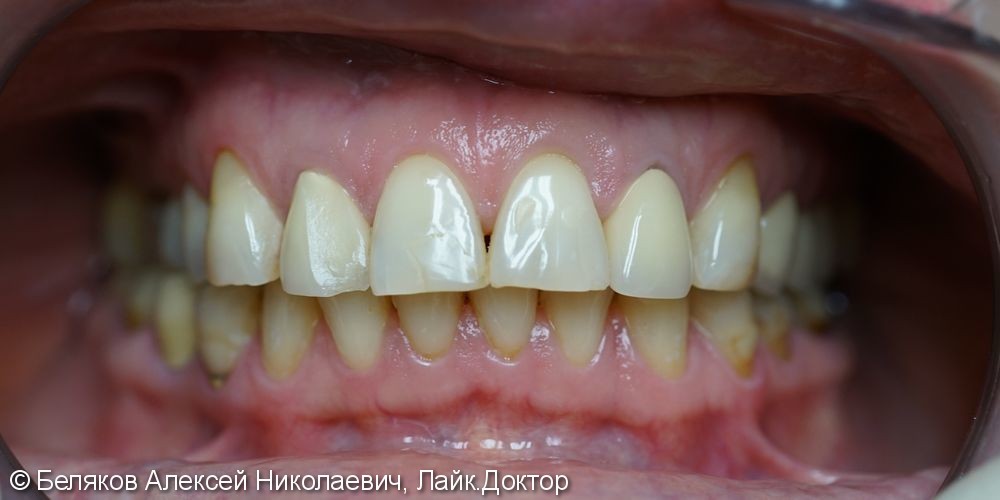 Эстетическое протезирование зубов верхней челюсти - фото №1