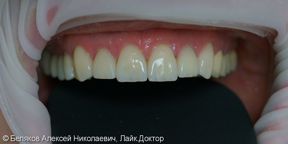 Эстетическое протезирование зубов верхней челюсти - фото №2