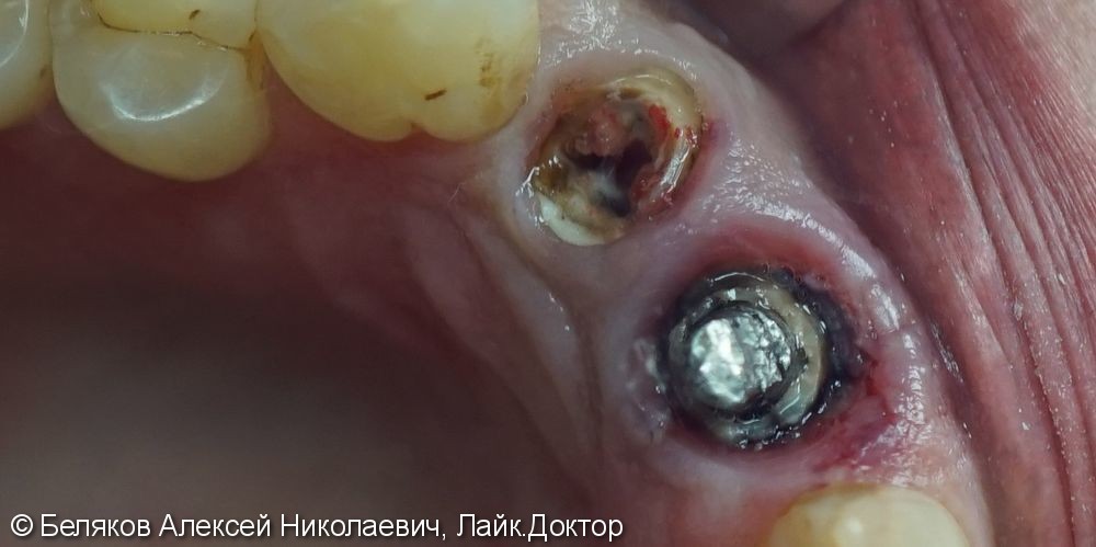 Одномоментная имплантация двух передних зубов - фото №1