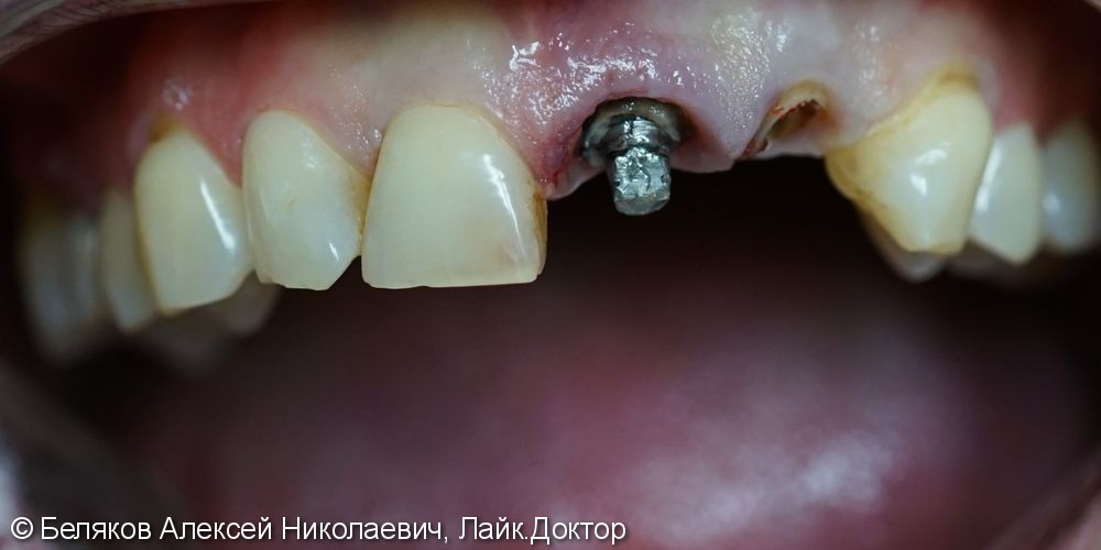 Одномоментная имплантация двух передних зубов - фото №2