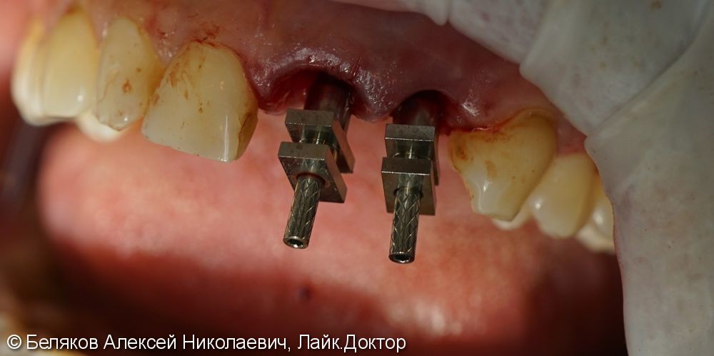 Одномоментная имплантация двух передних зубов - фото №3