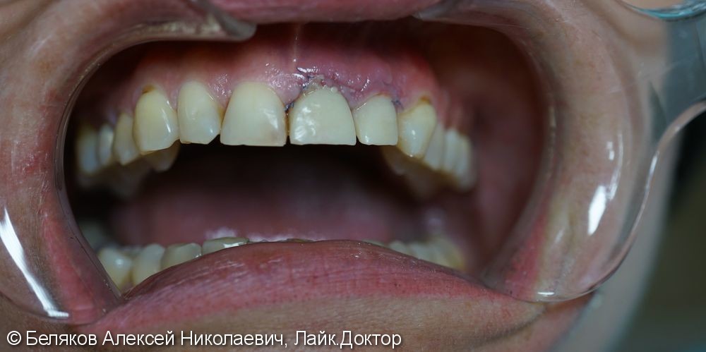 Одномоментная имплантация двух передних зубов - фото №4