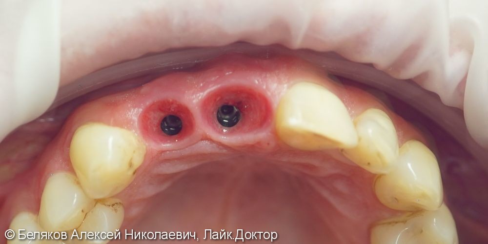 Одномоментная имплантация двух передних зубов - фото №6