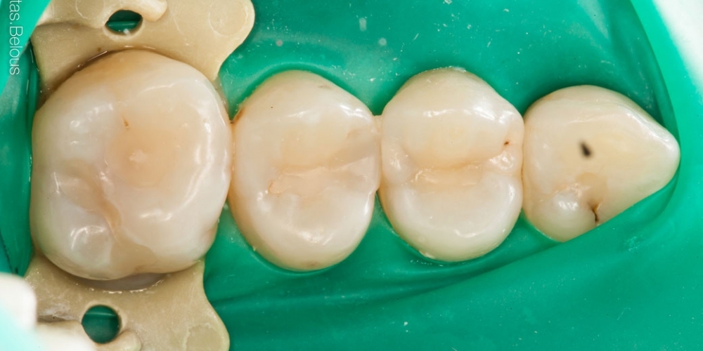 Скрытый кариес, лечение скрытых кариозных полостей на боковых поверхностях зубов - фото №1