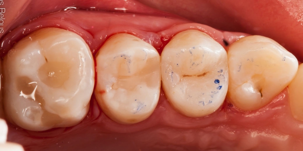 Скрытый кариес, лечение скрытых кариозных полостей на боковых поверхностях зубов - фото №5