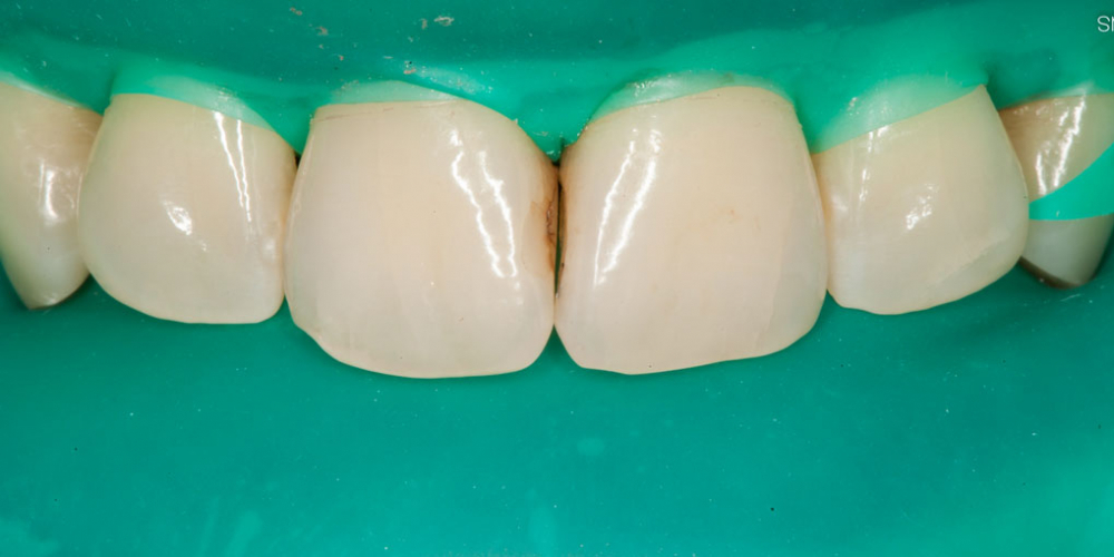 Лечение кариеса и реставрация передних зубов - фото №1