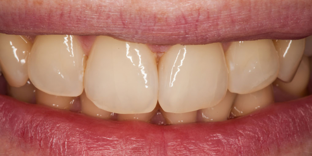 Лечение кариеса и реставрация передних зубов - фото №12