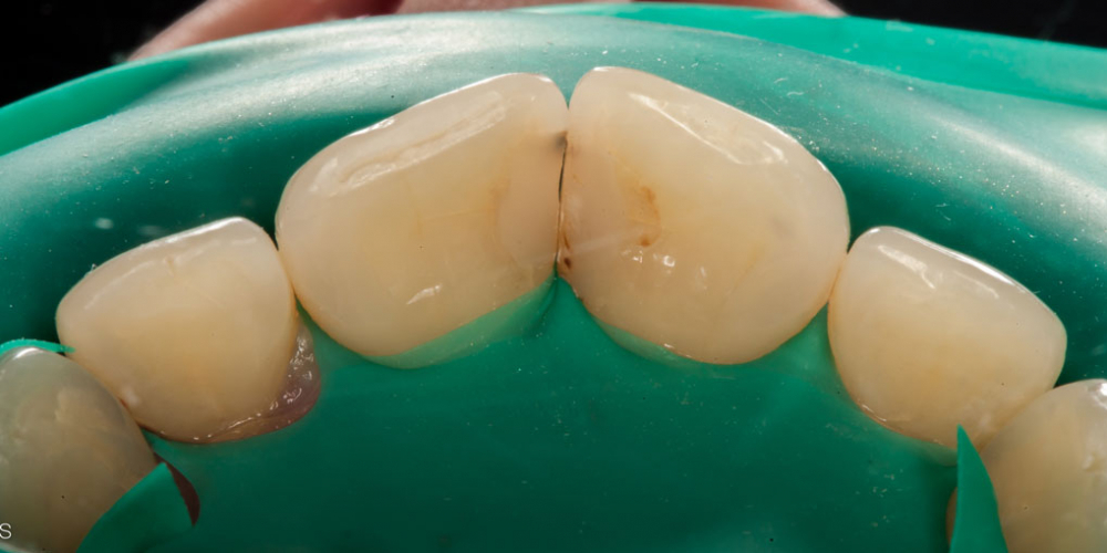 Лечение кариеса и реставрация передних зубов - фото №3