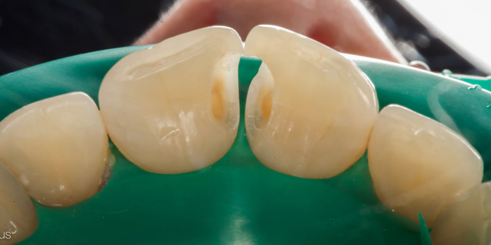Лечение кариеса и реставрация передних зубов - фото №4