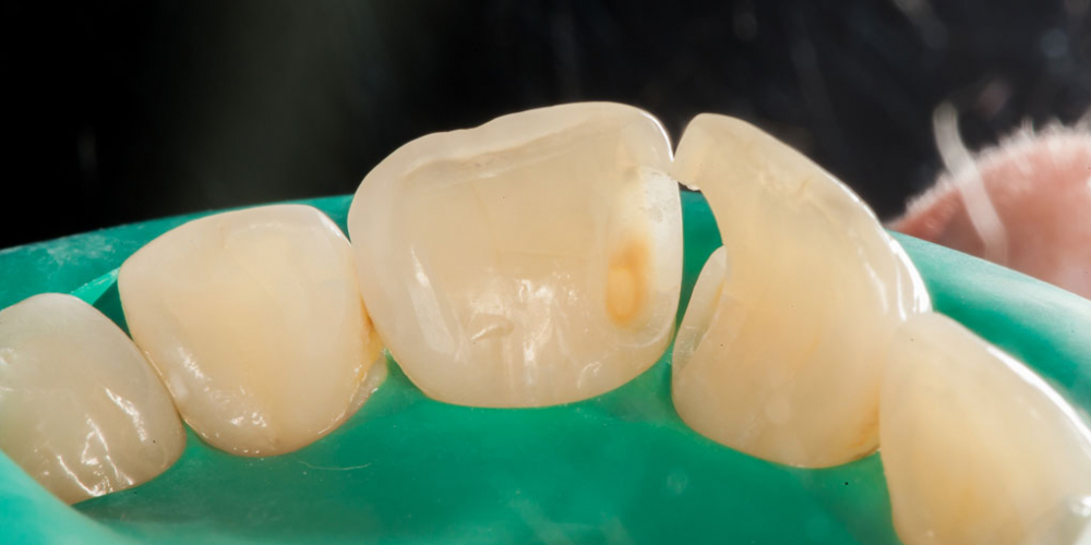 Лечение кариеса и реставрация передних зубов - фото №5